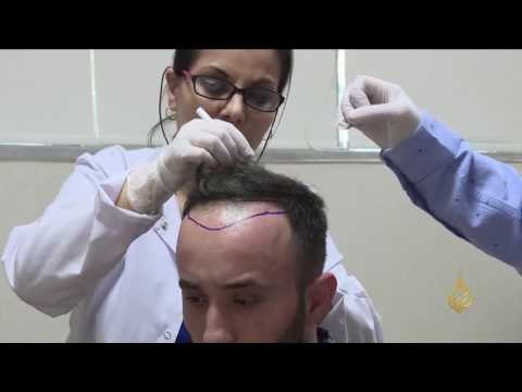 شاهد زراعة الشعر في تركيا تجتذب العرب والأوروبيين