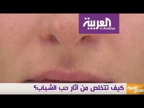 شاهد طرق فعالة ومختلفة لعلاج ندبات حب الشباب